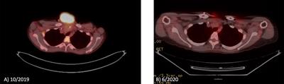 Case Report: Significant Response to the Combination of Lenvatinib and Immune Checkpoint Inhibitor in a Patient With Heavily Pretreated Metastatic Triple Negative Breast Cancer